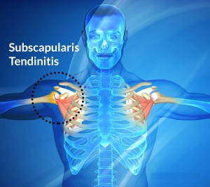 subscapularis-tendinitis