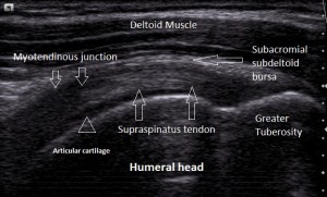 supraspinatus-ultra-sound